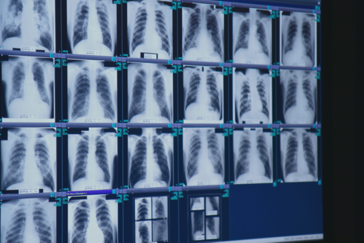 coal miners lungs severe black lung disease outbreak